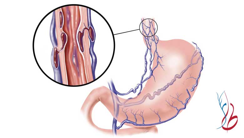 علت واریس معده چیست؟ نحوه تشخیص و روش های درمان