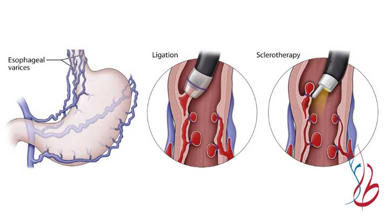 درمان واریس معده با اندوسکوپی