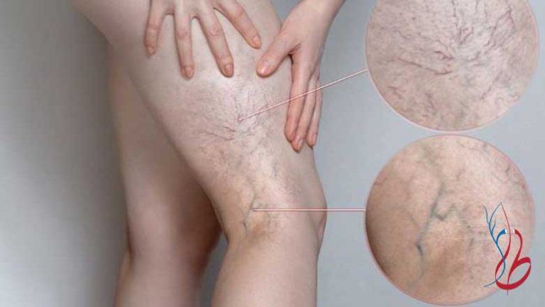 آیا واریس خطرناک است