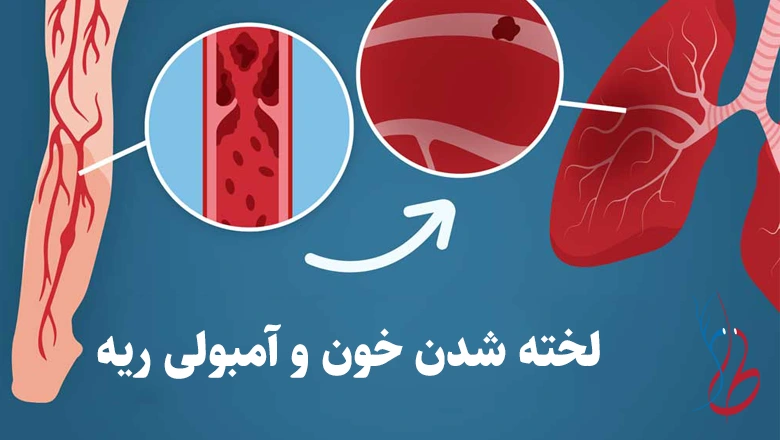 آیا واریس خطرناک است؟ خطرات بی توجهی به واریس 2 لخته شدن خون و آمبولی ریه