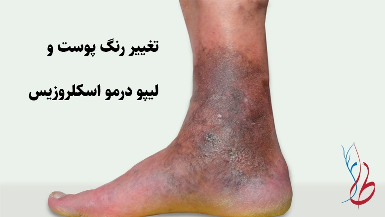 آیا واریس خطرناک است؟ خطرات بی توجهی به واریس 5 تغییر رنگ پوست و لیپو درمو اسکلروزیس