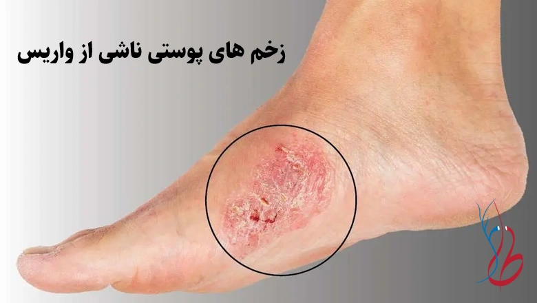 آیا واریس خطرناک است؟ خطرات بی توجهی به واریس 4 زخم های پوستی ناشی از واریس