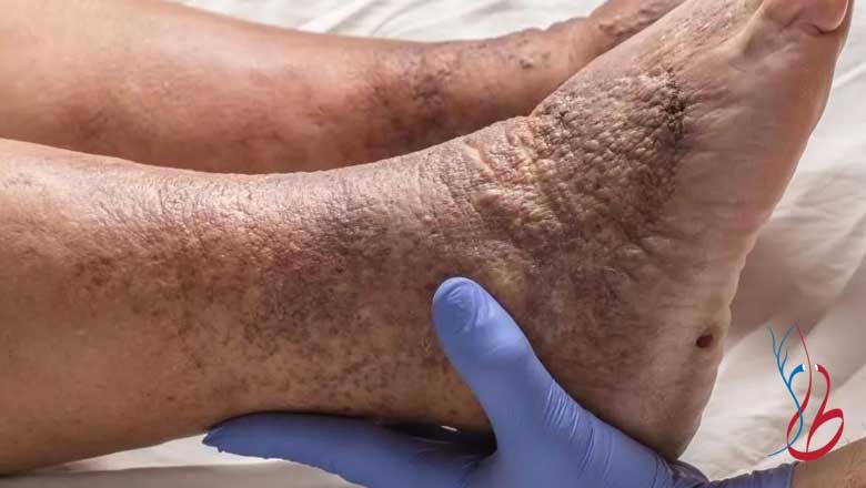 عکس انواع واریس پا از خفیف تا شدید؛ مچ و ساق پا {عکس قبل و بعد درمان} 30 زخم واریس