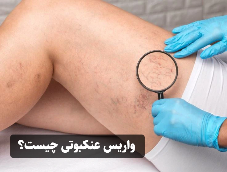 واریس عنکبوتی چیست