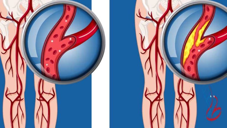 علائم چربی خون در پاها