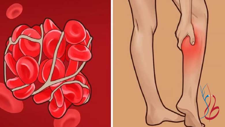 خون مردگی در پا نشانه چیست؟ 7 علت مهم اکیموز در پا 2 خون مردگی در پا