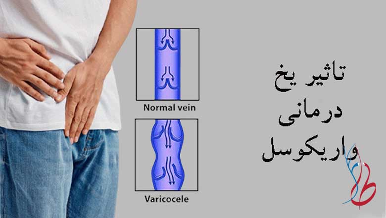 درمان واریکوسل با یخ | گذاشتن یخ روی بیضه ها چه تاثیری دارد؟ 4 تاثیر یخ در درمان واریکوسل