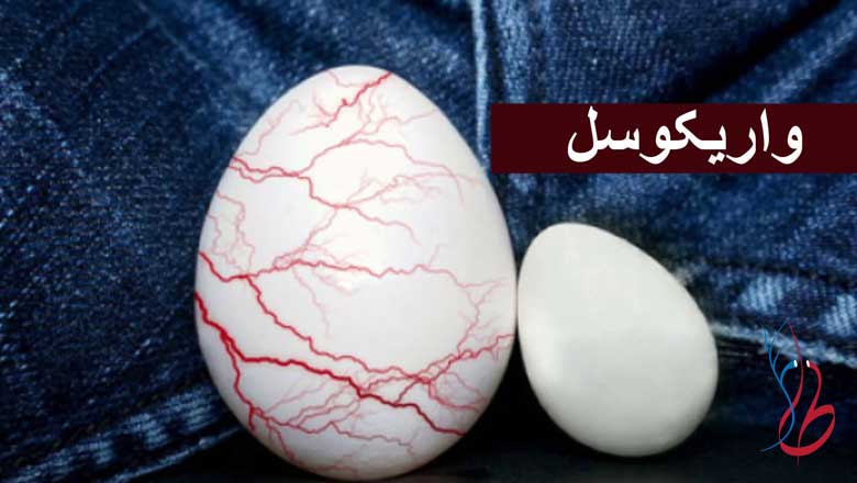 آیا واریکوسل باعث مرگ میشود؟ عوارض واریکوسل چیست؟ 4 تشخیص واریس بیضه