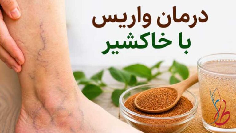 درمان واریس با خاکشیر