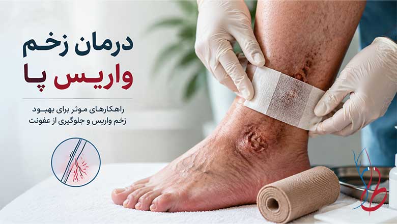 کلینیک فوق تخصصی درمان واریس دکتر طاهری 32 درمان زخم واریس پا