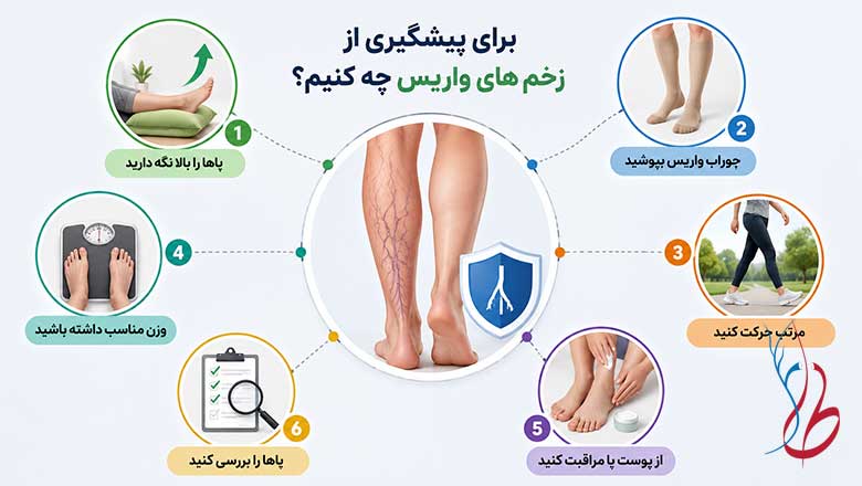 برای درمان زخم واریس پا چه کنیم؟ 13 راهکار سریع و موثر 6 برای پیشگیری از زخم های واریس چه کنیم؟